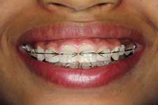 Braces Orthodontics