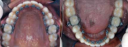 Braces Orthodontics