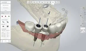 Digitally Guided Implants