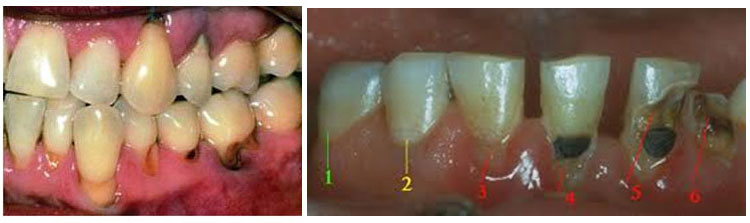 Root Caries