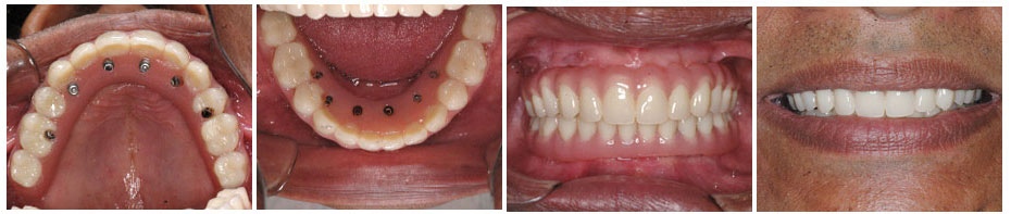 Graftless(Zygoma) Dental Implants
