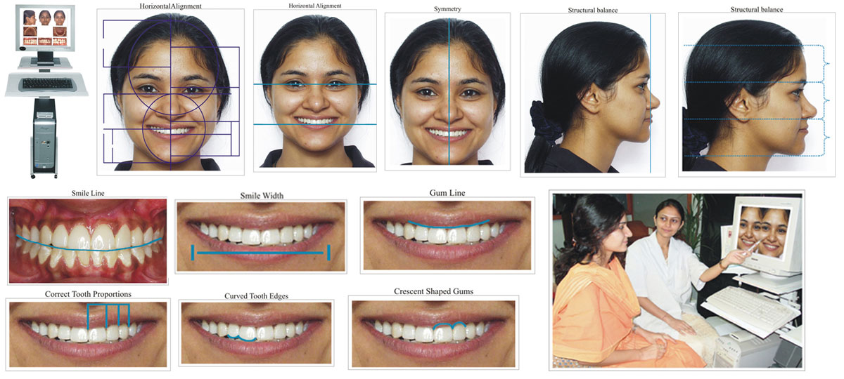 Smile Designing