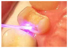 Laser Dentistry