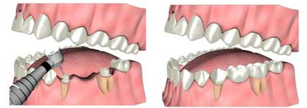 Smile Designing