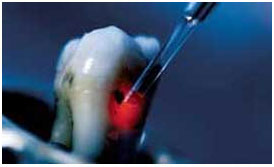 Laser Dentistry